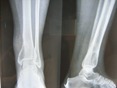 coimbatore-orthopaedic-joint-replacement-maternity-child-welfare-centre-india